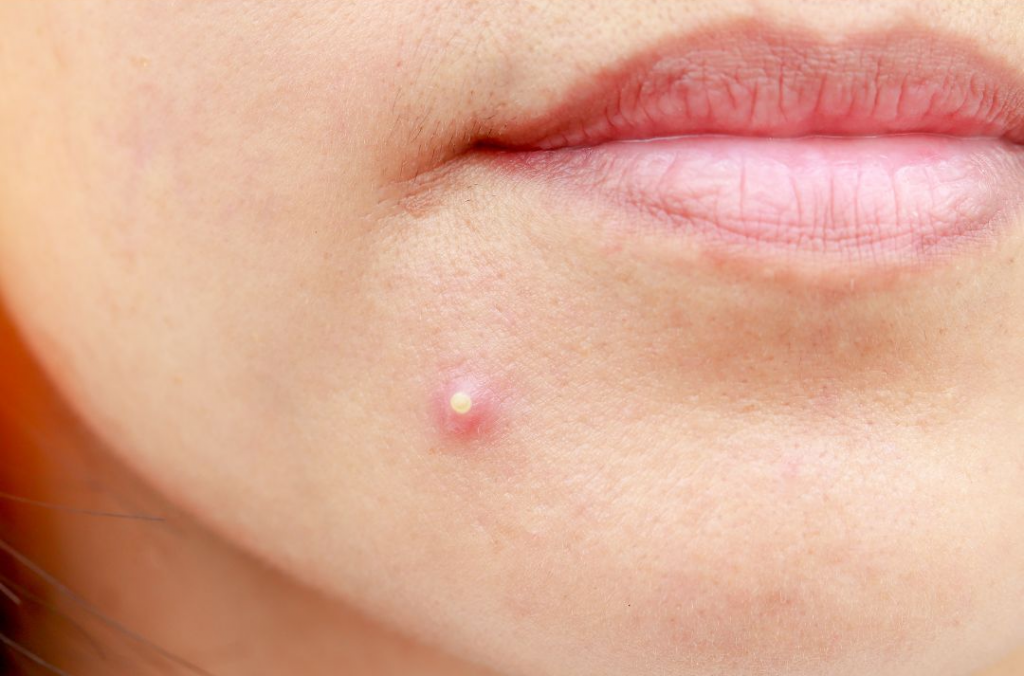 Sop y acne